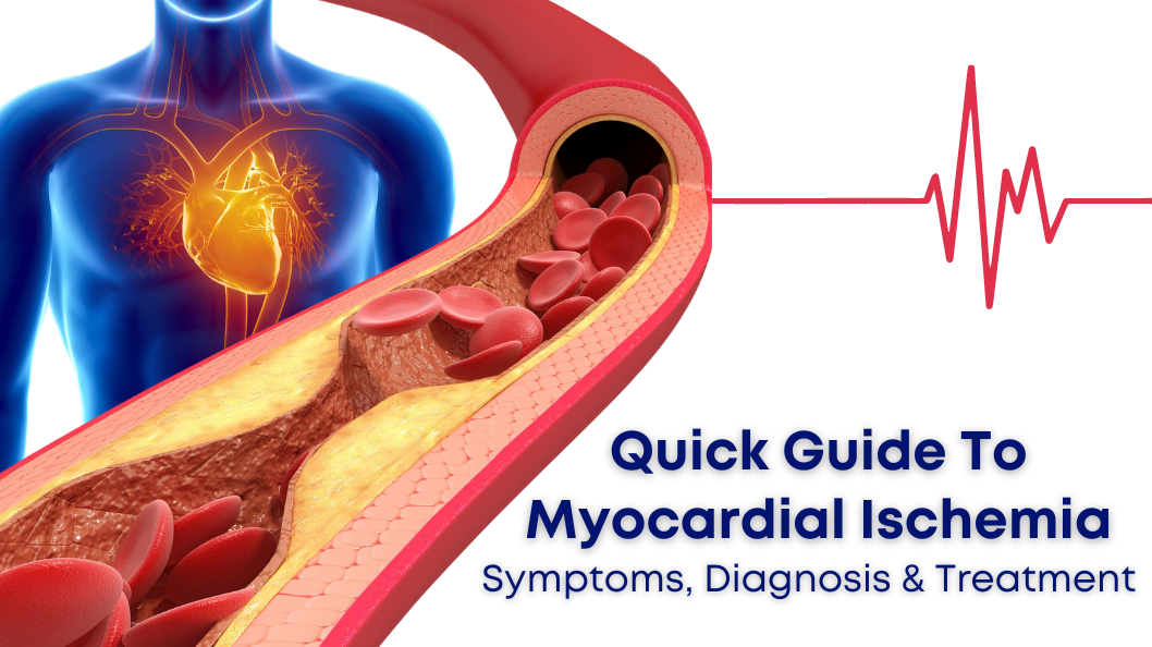Quick Guide to Myocardial Ischemia: Symptoms, Diagnosis & Treatment