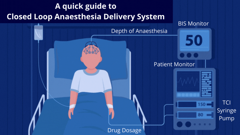 A quick guide to Closed Loop Anaesthesia Delivery System