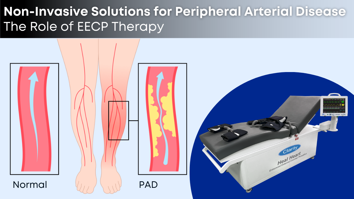 Non-Invasive Solutions for Peripheral Arterial Disease: The Role of EECP Therapy